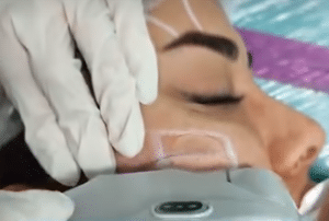 نمونه هایفوتراپی کلینیک زیبایی برنا