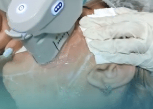 نمونه هایفوتراپی کلینیک زیبایی برنا