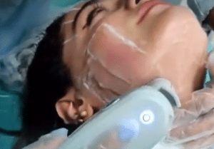 نمونه هایفوتراپی کلینیک زیبایی برنا