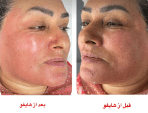 نمونه هایفوتراپی کلینیک زیبایی افسون