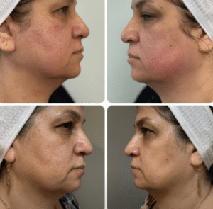 نمونه هایفوتراپی کلینیک زیبایی افسون