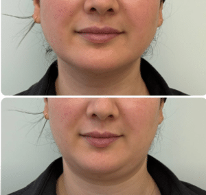 نمونه هایفوتراپی کلینیک زیبایی افسون