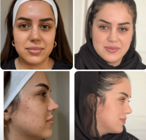 نمونه هایفوتراپی کلینیک زیبایی افسون