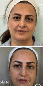 نمونه هایفوتراپی کلینیک زیبایی افسون