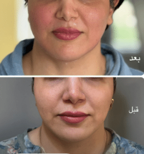 نمونه هایفوتراپی کلینیک زیبایی افسون