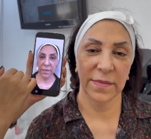 نمونه هایفوتراپی کلینیک زیبایی افسون