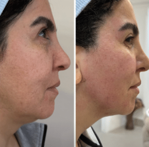 نمونه هایفوتراپی کلینیک زیبایی افسون