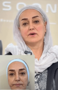 نمونه هایفوتراپی کلینیک زیبایی افسون