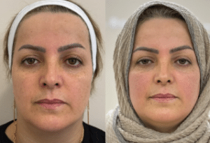 نمونه هایفوتراپی کلینیک زیبایی افسون