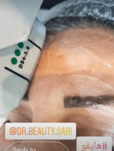 نمونه هایفوتراپی دکتر نرگس رستمیان