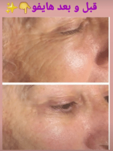 نمونه هایفوتراپی دکتر نرگس رستمیان