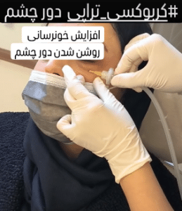 نمونه کربوکسی تراپی دکتر رجا قلیان