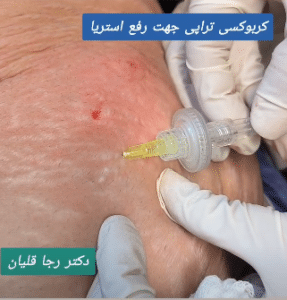 نمونه کربوکسی تراپی دکتر رجا قلیان