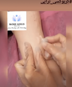نمونه کربوکسی تراپی کلینیک زیبایی رزگلد