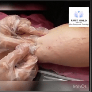 نمونه کربوکسی تراپی کلینیک زیبایی رزگلد