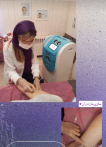 نمونه کربوکسی تراپی کلینیک زیبایی رزگلد