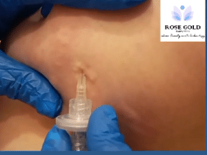 نمونه کربوکسی تراپی کلینیک زیبایی رزگلد