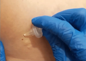 نمونه کربوکسی تراپی کلینیک زیبایی رزگلد