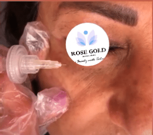 نمونه کربوکسی تراپی کلینیک زیبایی رزگلد