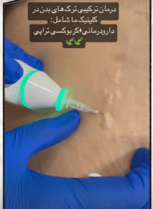 نمونه کربوکسی تراپی دکتر سجر مروج