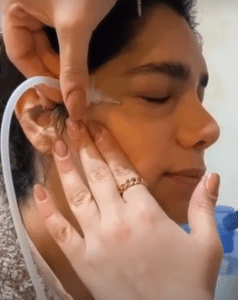 نمونه کربوکسی تراپی مرکز آرا پوست