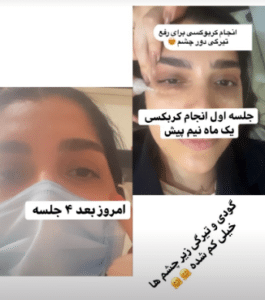 نمونه کربوکسی تراپی مرکز آرا پوست