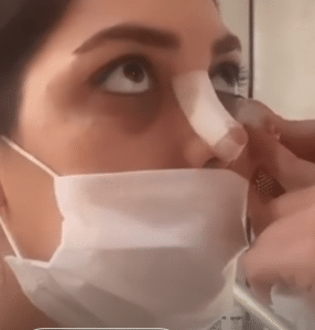 نمونه کربوکسی تراپی مرکز آرا پوست