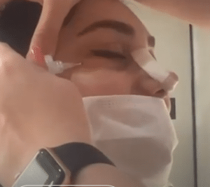 نمونه کربوکسی تراپی مرکز آرا پوست