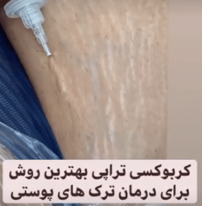نمونه کربوکسی تراپی مرکز آرا پوست