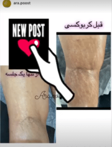 نمونه کربوکسی تراپی مرکز آرا پوست