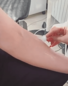 نمونه کربوکسی تراپی مرکز آرا پوست