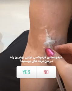 نمونه کربوکسی تراپی مرکز آرا پوست