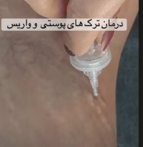 نمونه کربوکسی تراپی مرکز آرا پوست