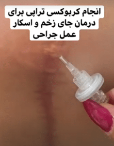 نمونه کربوکسی تراپی مرکز آرا پوست
