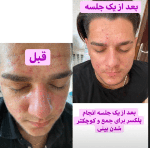نمونه کربوکسی تراپی مرکز آرا پوست