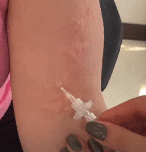 نمونه کربوکسی تراپی مرکز آرا پوست