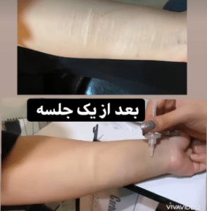 نمونه کربوکسی تراپی مرکز آرا پوست