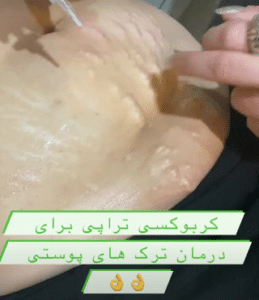 نمونه کربوکسی تراپی مرکز آرا پوست