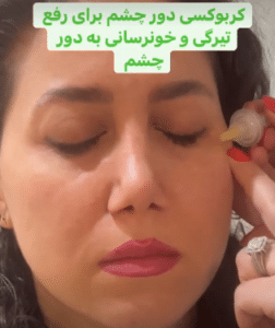 نمونه کربوکسی تراپی مرکز آرا پوست