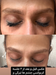 نمونه کربوکسی تراپی مرکز آرا پوست