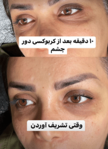 نمونه کربوکسی تراپی مرکز آرا پوست