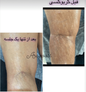 نمونه کربوکسی تراپی مرکز آرا پوست