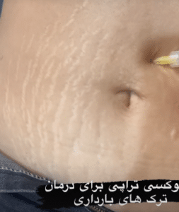 نمونه کربوکسی تراپی مرکز آرا پوست