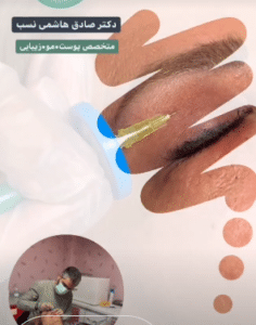 نمونه کربوکسی تراپی دکتر صادق هاشمی نسب