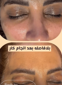 نمونه کربوکسی تراپی دکتر صادق هاشمی نسب