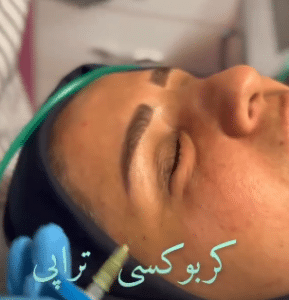 نمونه کربوکسی تراپی دکتر صادق هاشمی نسب