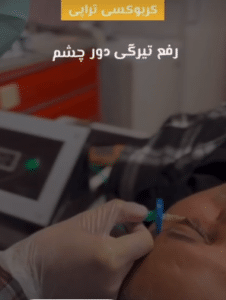 نمونه کربوکسی تراپی دکتر صادق هاشمی نسب