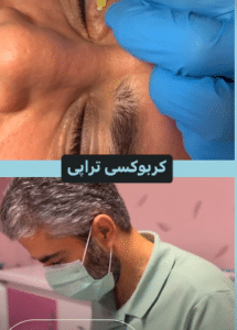 نمونه کربوکسی تراپی دکتر صادق هاشمی نسب
