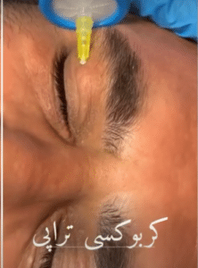 نمونه کربوکسی تراپی دکتر صادق هاشمی نسب