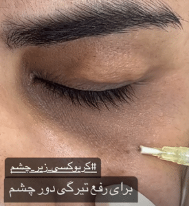 نمونه کربوکسی تراپی دکتر زهرا نورانی